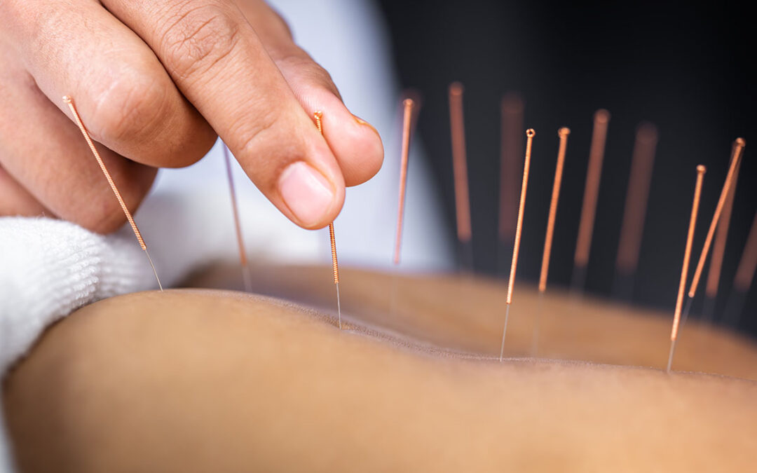 Yamamoto New Scalp Acupuncture (YNSA) in Stroke Patient Rehabilitation