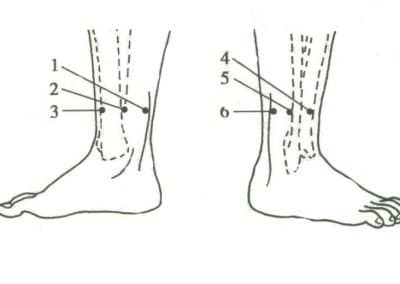 Wrist-Ankle Acupuncture (WAA)